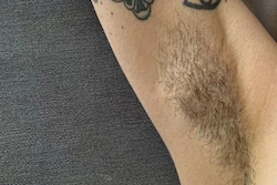 Permanent hair removal at home