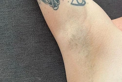 Reduced underarm hair with pain-free laser hair removal at your own home