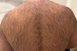 Laser hair removal of body hair for men