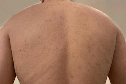 Body hair reduced by 80% after only three home laser hair removal sessions