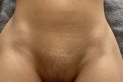 Laser hair removal in the comfort of your own home in Harrogate