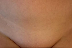 Laser hair removal in your own home with the same practitioner throughout your course