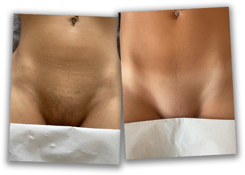 A before an after shot of a customer's bikini area, which shows some dark hairs before treatment, and is perfectly smooth after laser hair removal treatment.