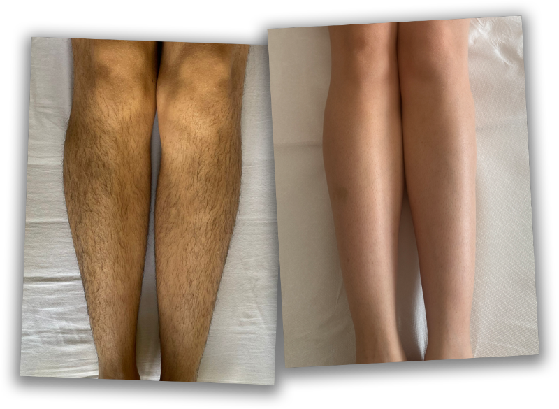 A before an after shot of a pair of legs showing hairy legs before laser hair removal and smooth, hair-free legs post treatment.