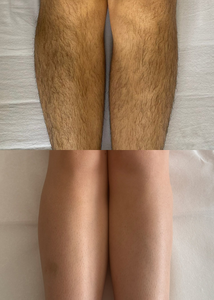 Shots of a pair of legs before and after receiving laser hair removal treatment. The top half of the image shows the legs covered in short, dark hairs, while the bottom half shows the same legs completely smooth and hair free.